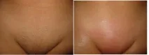 Крем для депіляції інтимних зон - відгуки, який краще - Veet, Velvet і т.д. крем