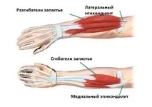 Лікування епікондиліту ліктьового суглоба народними засобами засобами