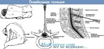 Люмбальна пункція у дітей пункція