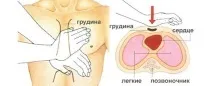 Зупинка серця - причини, симптоми, перша допомога та лікування перша