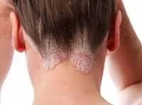себорейний