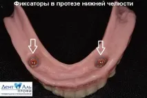 Сучасне вирішення проблем поганої фіксації знімних протезів нижньої щелепи сучасне