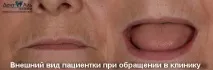Сучасне вирішення проблем поганої фіксації знімних протезів нижньої щелепи вирішення