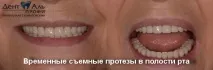 Сучасне вирішення проблем поганої фіксації знімних протезів нижньої щелепи проблем