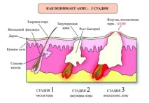 негормональніпричини