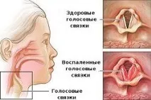 ларингіт
