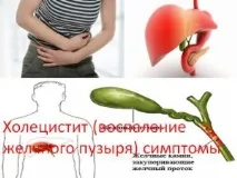 холецистит