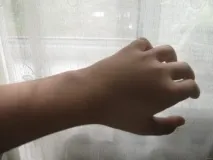 перелом