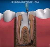 Періодонтит - захворювання прикореневих тканин зуба прикореневих