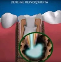 Періодонтит - захворювання прикореневих тканин зуба захворювання