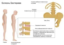 Simptomele și tratamentul spondilitei anchilozante