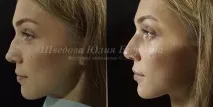 Щелепно-лицьова хірургія - нитки Аптос щелепно-лицьова