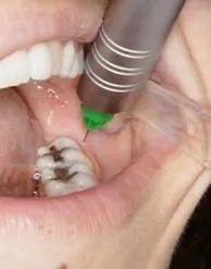 DentalHiTec інноваційні рішення стоматологічної анестезії рішення