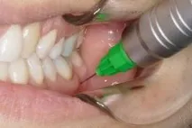 DentalHiTec інноваційні рішення стоматологічної анестезії інноваційні