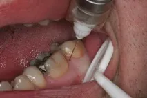 DentalHiTec інноваційні рішення стоматологічної анестезії стоматологічної