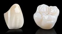 Фото цирконієвих коронок та безметалової кераміки, Гід за Стоматологією. кераміки