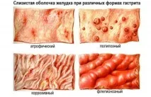 Гастрит, симптоми, лікування народними засобами гастрит
