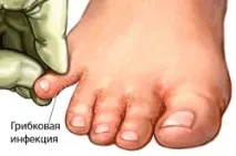 Грибок на ногах симптоми та перші ознаки перші