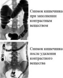 кишечника