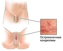 бородавок