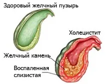 Як приймати картопляний сік при панкреатиті та холециститі. холециститі