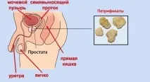 Камені у простаті причини освіти, симптоми та способи лікування простаті
