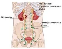 Метастази без первинного вогнища прогноз, симптоми, стадії, лікування метастази