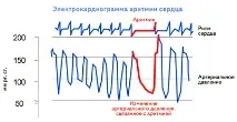 Порушення ритму серця та провідності ритму