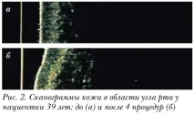 Оцінка клінічної ефективності препарату Meso-Xanthin F199 оцінка