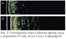 Оцінка клінічної ефективності препарату Meso-Xanthin F199 ефективності