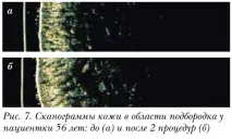 Оцінка клінічної ефективності препарату Meso-Xanthin F199 клінічної