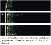 Оцінка клінічної ефективності препарату Meso-Xanthin F199 препарату