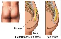 Пілонідальна кіста – патологія, що приносить багато дискомфорту. кіста