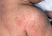 Пітниця у дітей дітей
