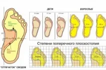 Поздовжня плоскостопість 3 ступеня симптоми та лікування ступеня