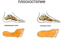 Поздовжня плоскостопість 3 ступеня симптоми та лікування ступеня