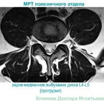 междупрешленния