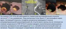 Інтервенційна радіологія в лікуванні онкологічних захворювань. інтервенційна