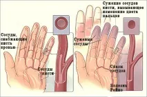 Синдром Рейно причини, симптоми, лікування лікування