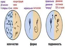 тератозооспермия