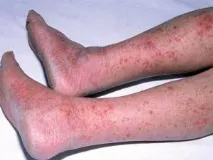 Варикозний дерматит нижніх кінцівок лікування медикаментозними та народними засобами, а також варикозний