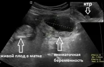 Позаматкова вагітність після ЕКЗ причини та симптоми патології симптоми