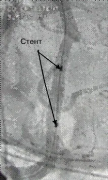 стент