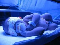 Жовтизна у новонароджених життя