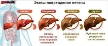Шлункова кровотеча при цирозі печінки цирозі