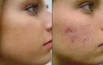 Акне причини виникнення причини