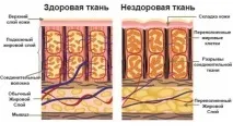 Антицелюлітна дієта на 10 днів антицелюлітна