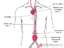 аневризма