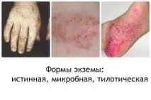 Дисгідротична екзема дисгідротична