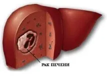 Діабет та рак чи є зв’язок діабет